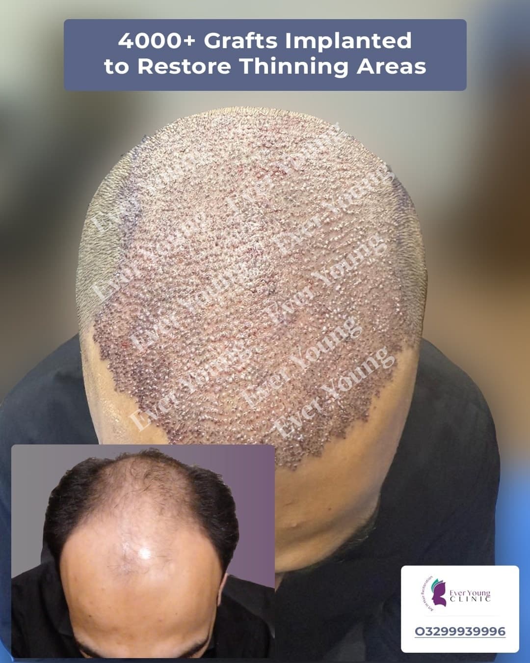 Hair transplant patient after 4000+ grafts implanted to restore thinning areas at Ever Young Clinic