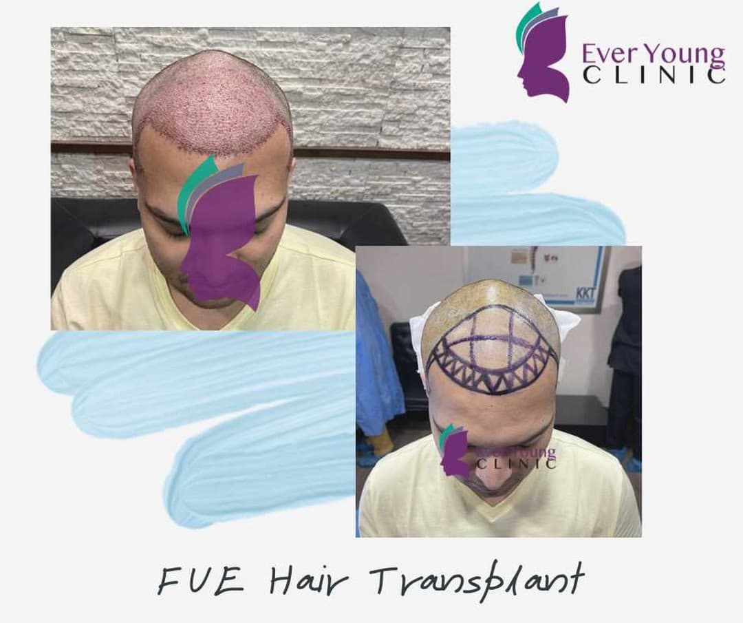 FUE hair transplant hairline design and freshly implanted grafts by Dr. Wajeeha Ashar