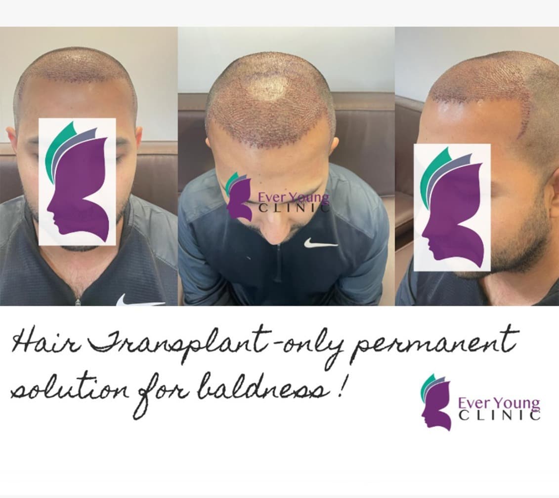Hair transplant patient after 4000+ grafts implanted to restore thinning areas at Ever Young Clinic