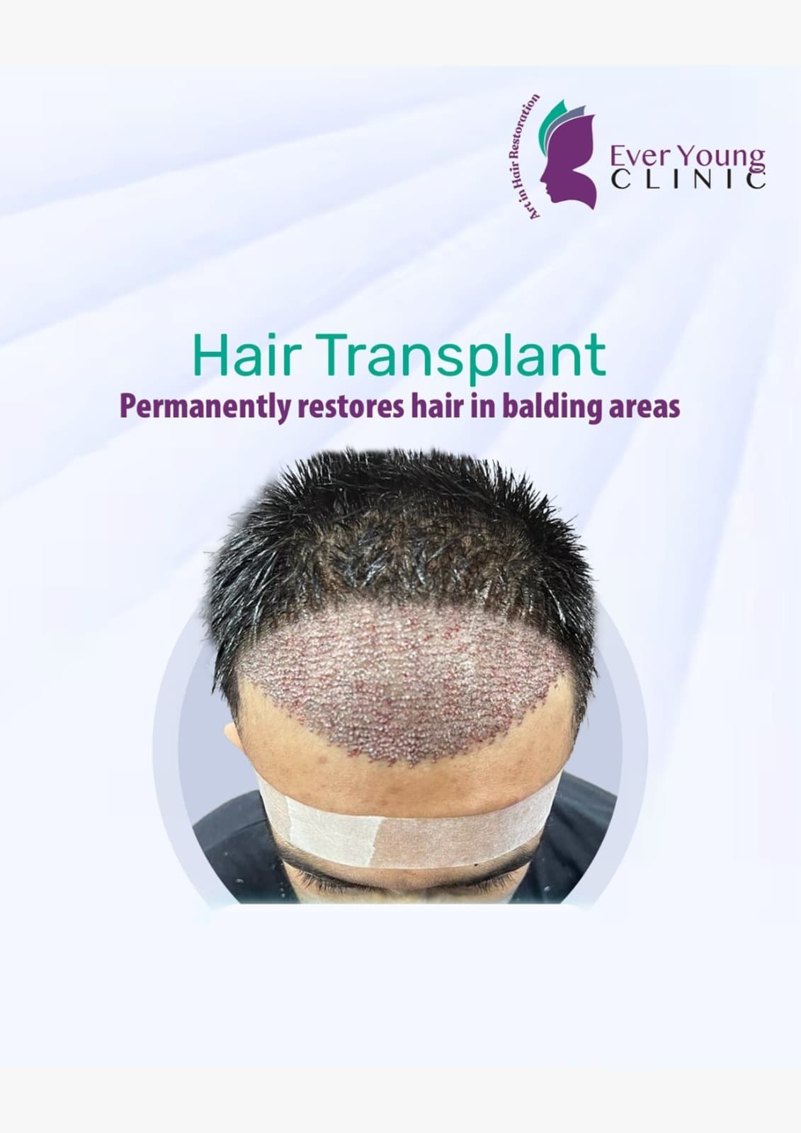 Hair transplant patient after 4000+ grafts implanted to restore thinning areas at Ever Young Clinic