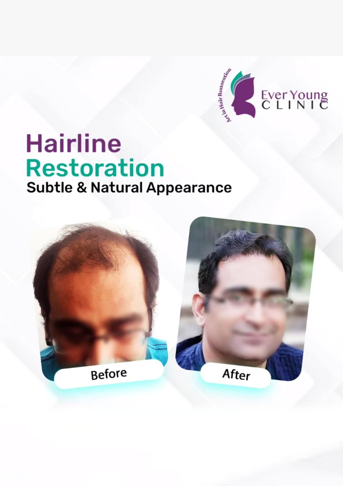 Hair transplant patient after 4000+ grafts implanted to restore thinning areas at Ever Young Clinic