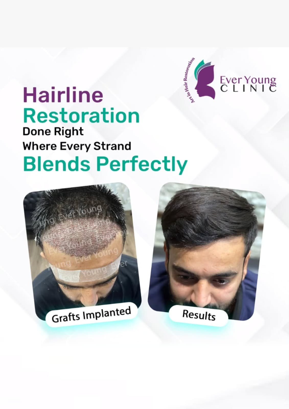Hair transplant patient after 4000+ grafts implanted to restore thinning areas at Ever Young Clinic