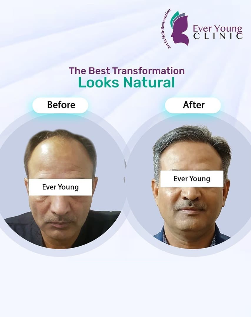 Hair transplant patient after 4000+ grafts implanted to restore thinning areas at Ever Young Clinic
